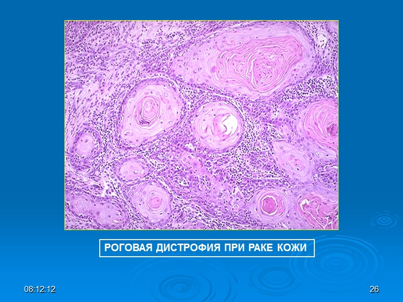 РОГОВАЯ ДИСТРОФИЯ ПРИ РАКЕ КОЖИ 08:12:01 26